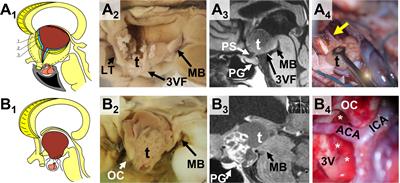 Craniopharyngioma and the Third Ventricle: This Inescapable Topographical Relationship